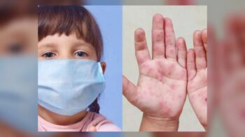 Alerta en Jalisco: Suman 230 casos de coxsackie con contagios en tres escuelas