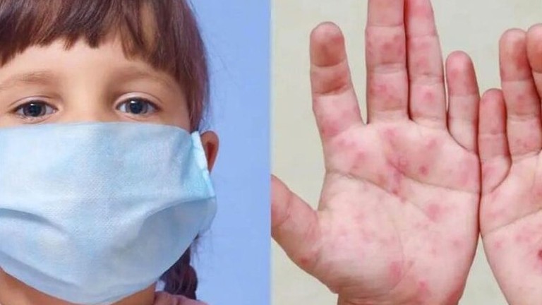 Alerta en Jalisco: Suman 230 casos de coxsackie con contagios en tres escuelas